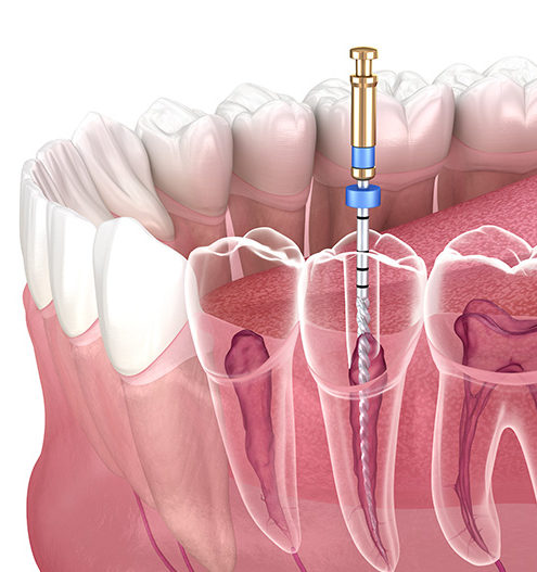 Endodontologie - Ansicht von Zahnwurzelbehandlung