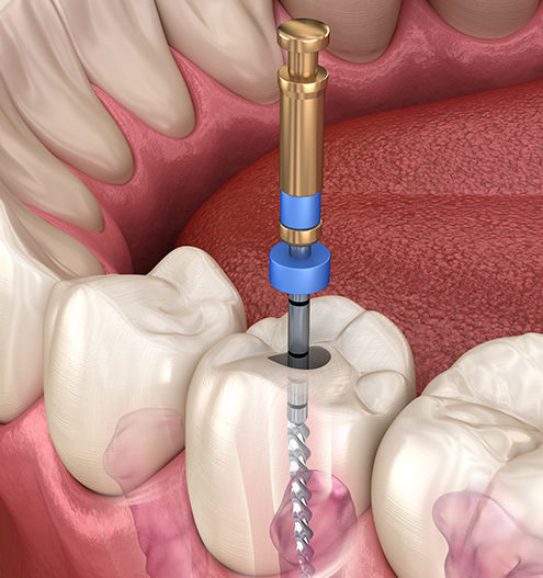 Endodontologische Behandlung: Schematische Abbildung einer Zahnwurzelbehandlung