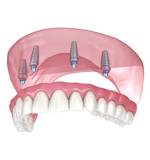 Schematic drawing: Dental implants hold maxillary prosthesis