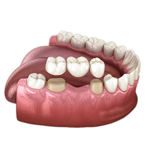 Dental bridge held by two implants