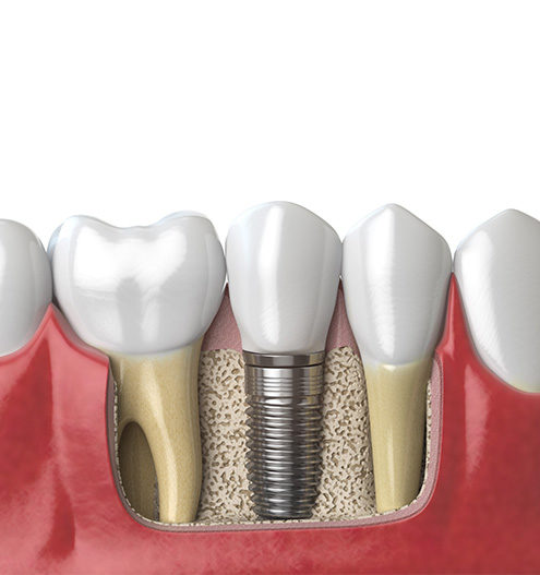 Denture fixed in the jaw by implant