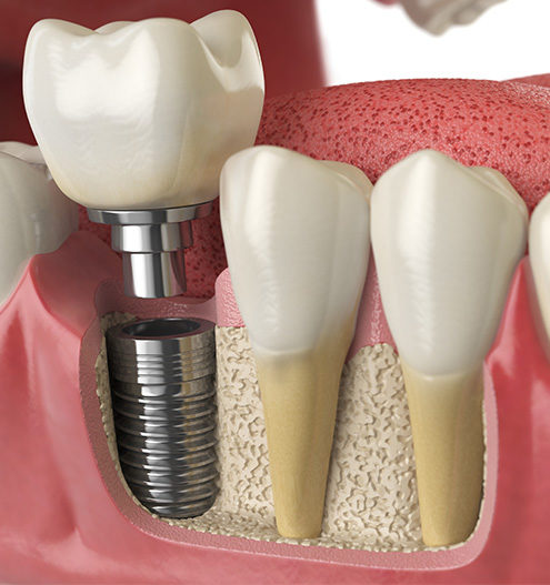 Crown and abutment are fixed in dental implant