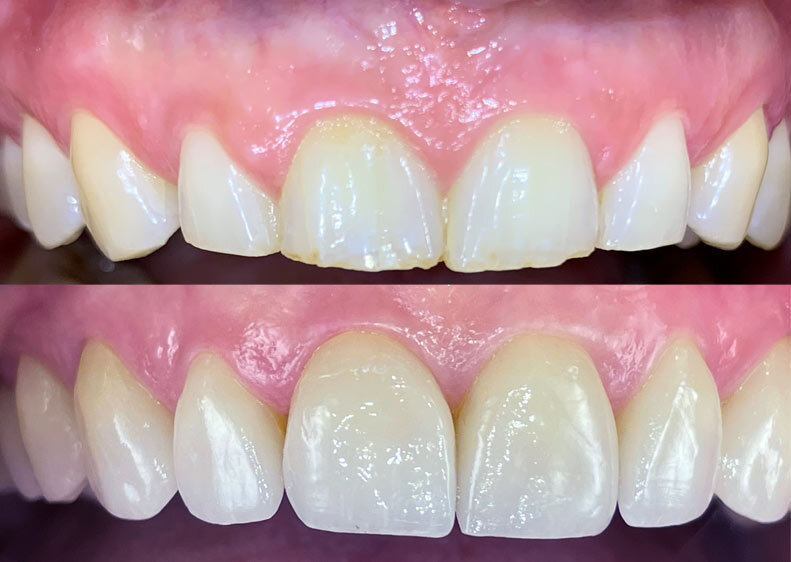 Veneers treatment - before and after picture